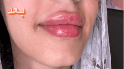 قبل-وبعد-فيلر-شفايف-1