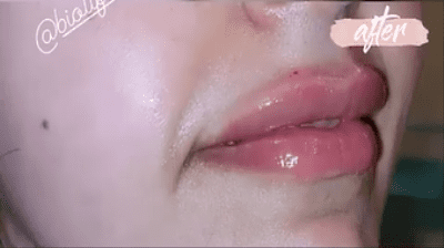 قبل-وبعد-فيلر-شفايف-3