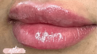 قبل-وبعد-فيلر-شفايف-5