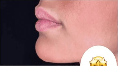 قبل-وبعد-فيلر-شفايف-6