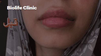 قبل-وبعد-فيلر-شفايف